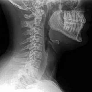 X-ray image of a jaw and cervical vertebrae.