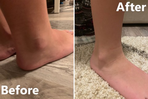 Before and after of sprained ankle